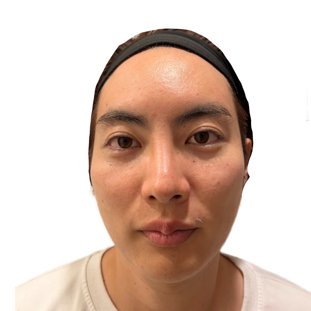 マヌカフェイシャル（ダーマペン4）